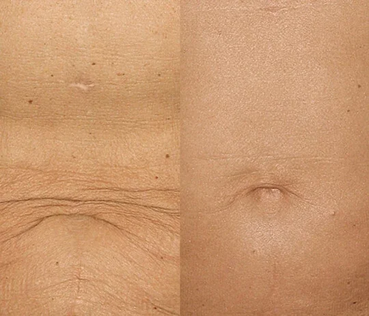 Anti-Wrinkles