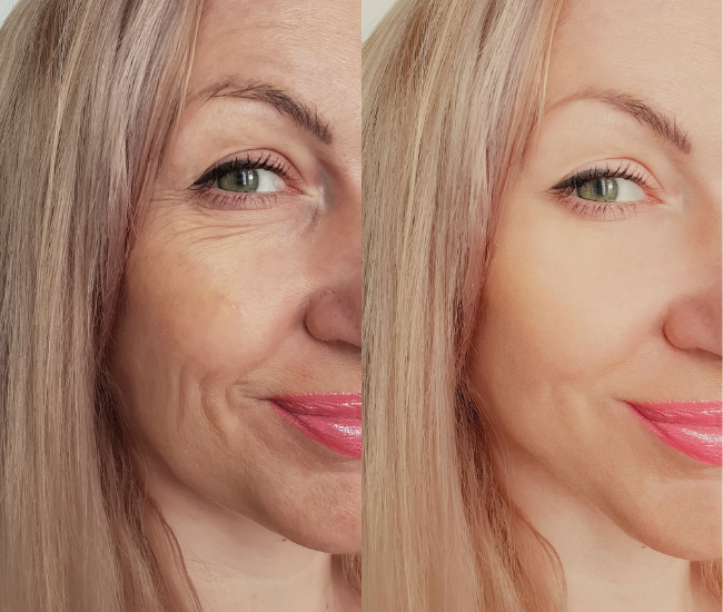 Anti-Wrinkles