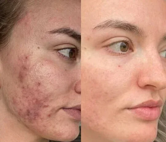 Anti-Wrinkles