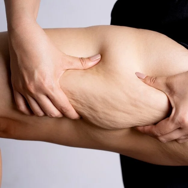 Cellulite Structural Changes