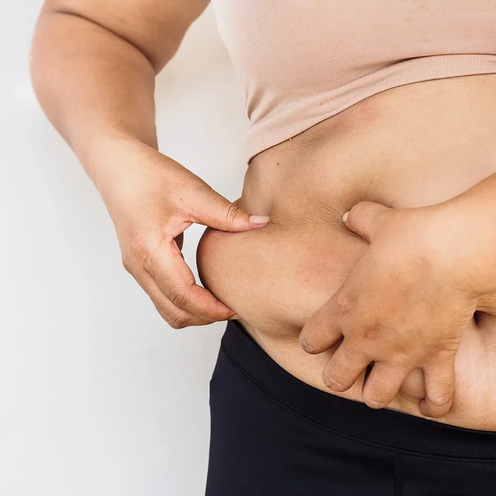 Localised Stubborn Fat Deposits