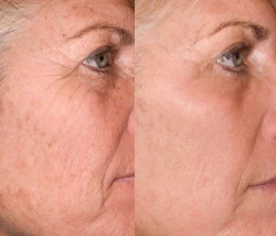 Anti-Wrinkles