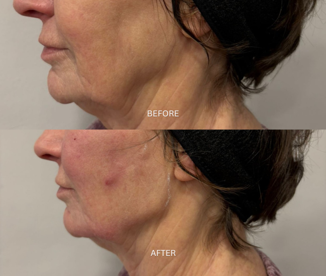 Skin Tightning