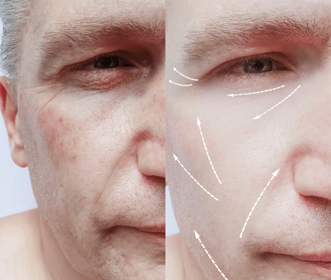 Anti-Wrinkles
