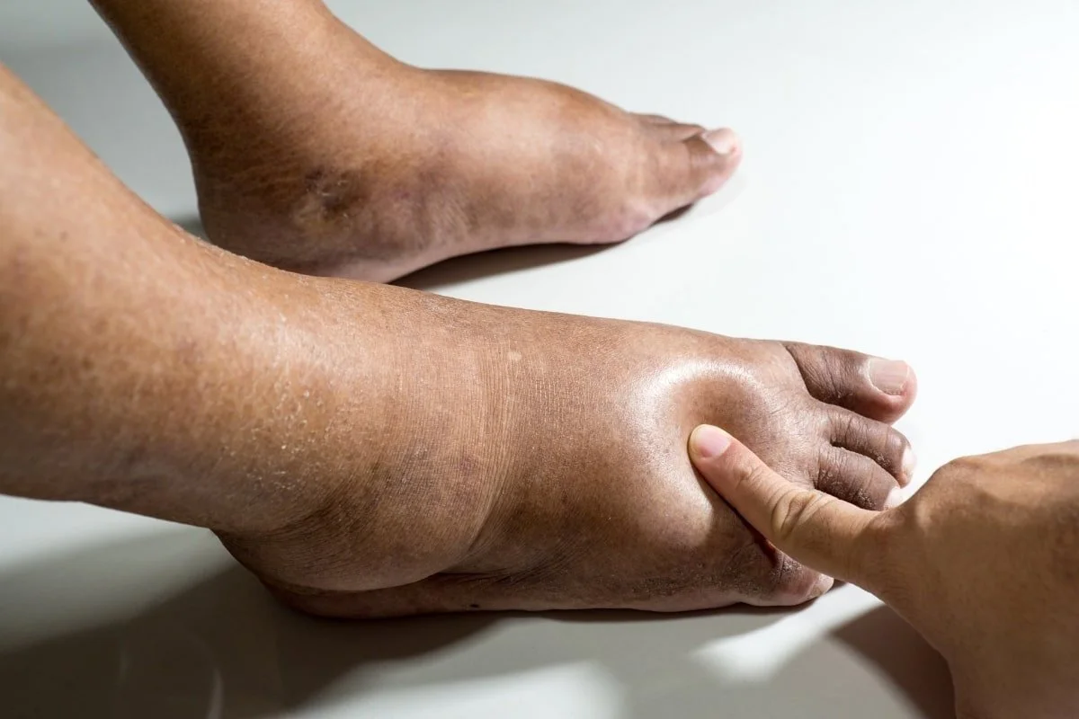 Edematous Tissue Puffiness