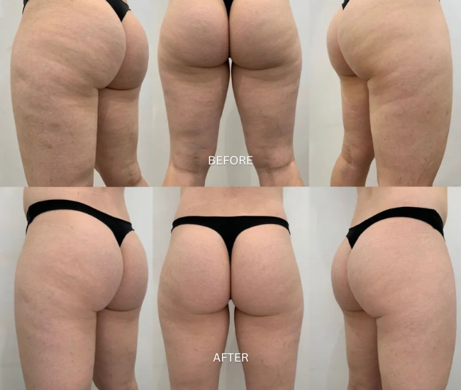 Body Transformation