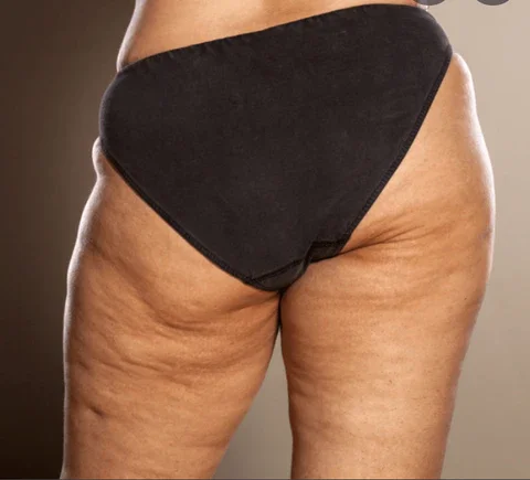 Edematous Cellulite