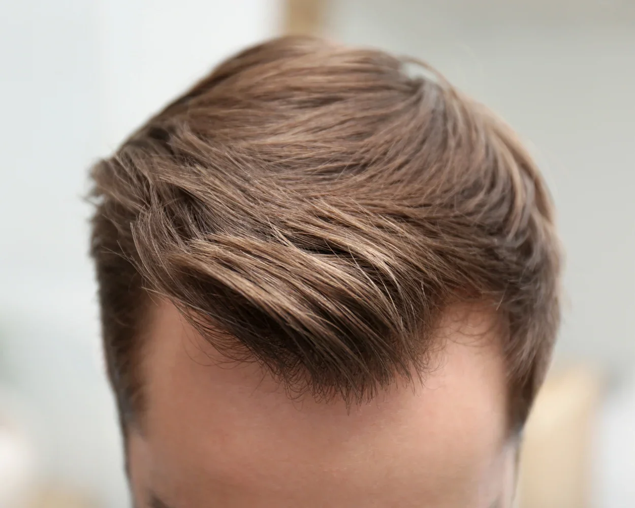 Receding Hairline & Temple Softening