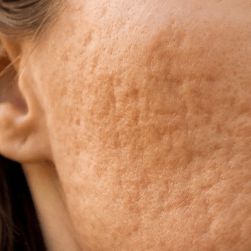 Uneven Skin Tone & Mottled Pigmentation