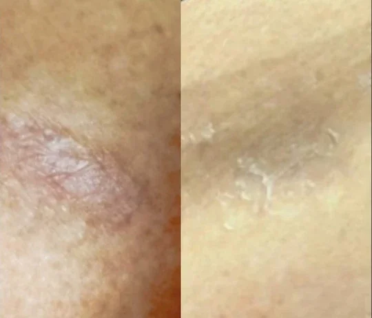 Anti-Wrinkles