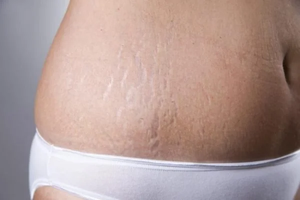 Striae Albae