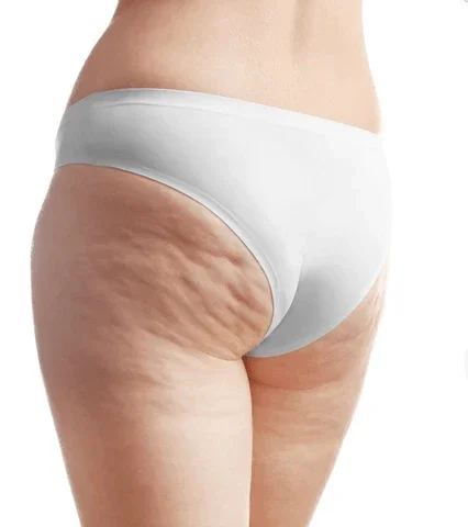 Flaccid & Lax Cellulite