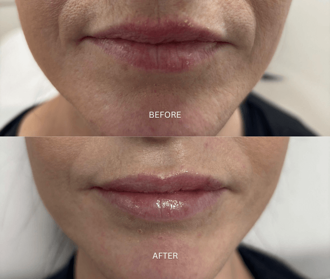 Anti-Wrinkles