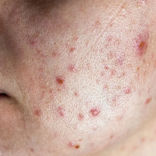 Acne Vulgaris & Blemish