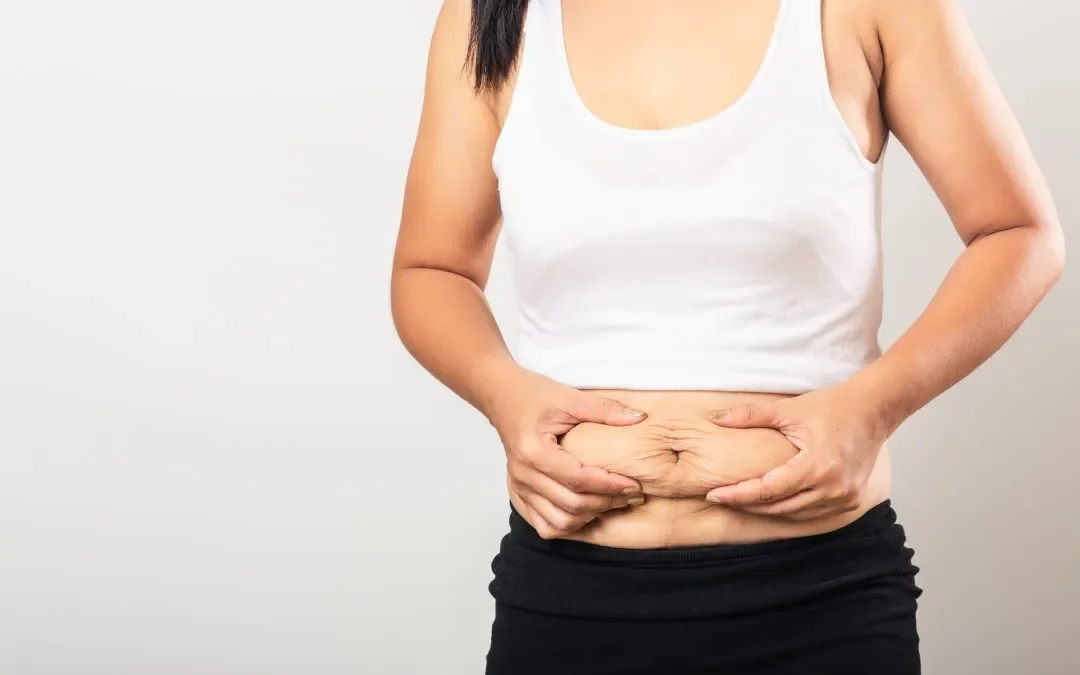 Post-Weight Loss Tissue Slackness