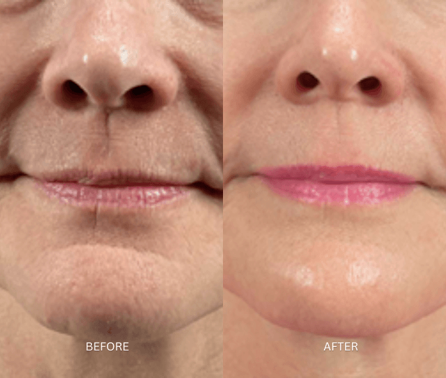 Skin Tightning