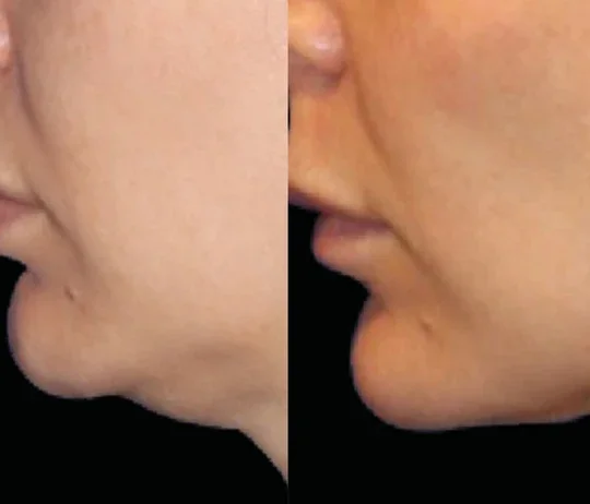 Anti-Wrinkles