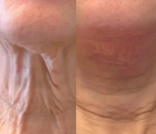 Anti-Wrinkles