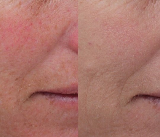 Anti-Wrinkles