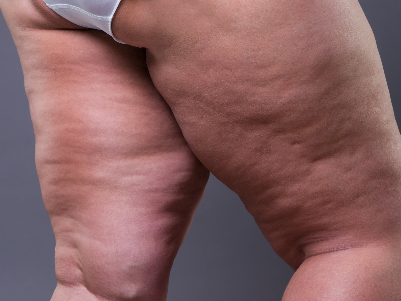 Fibrotic Cellulite