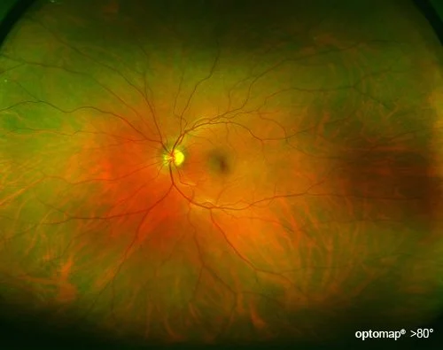 Colorful image of a human retina showing the optic nerve and blood vessels, with the optic disc slightly yellowish.