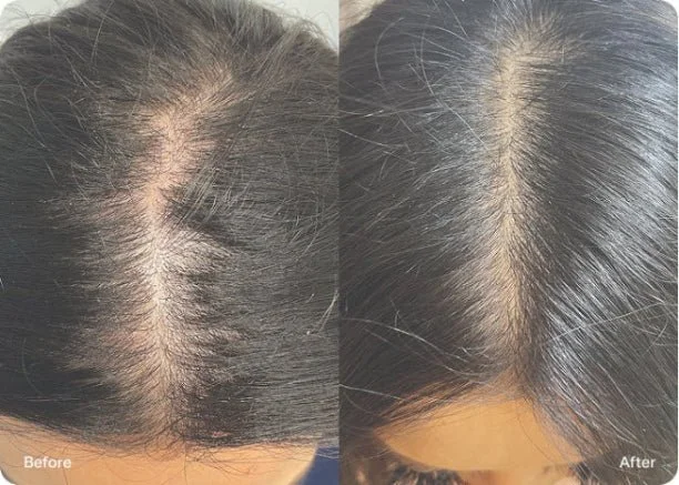 Comparison of hair on a woman's scalp before and after treatment, showing increased hair density and reduced scalp visibility in the after image.