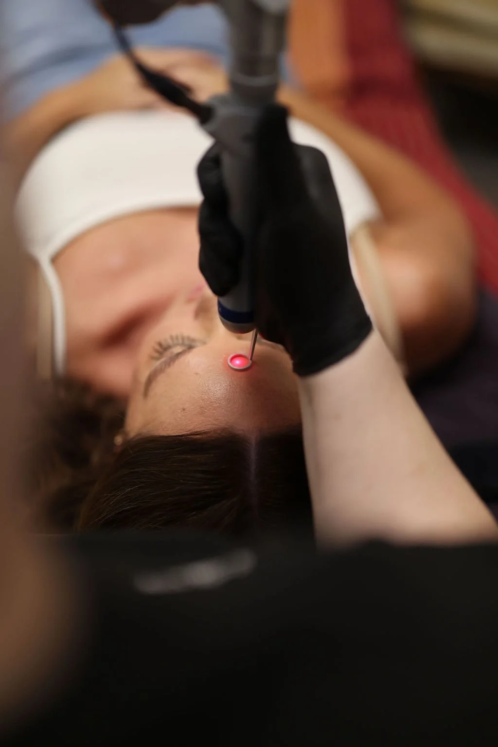 A person lying down while a healthcare professional in black gloves performs PicoWay laser treatment on their forehead.