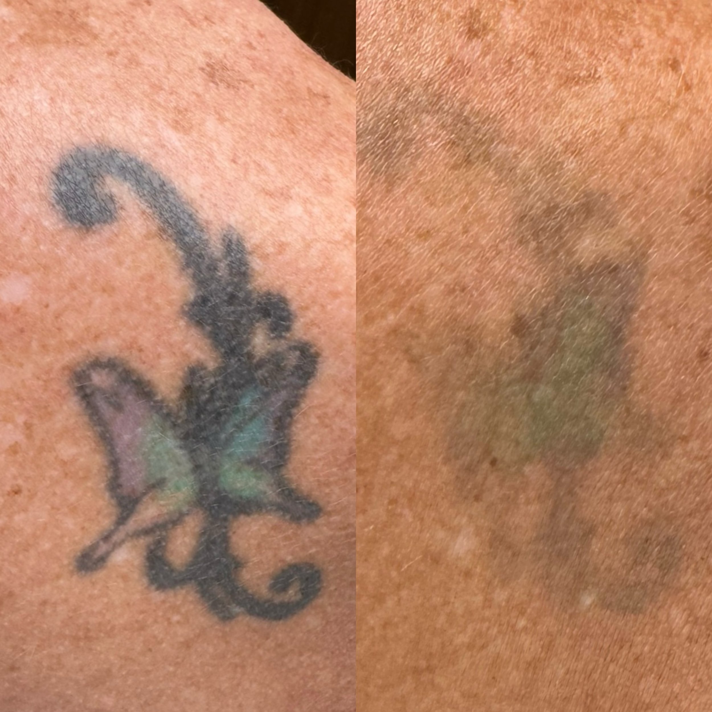 The butterfly slowly flying away 🦋 

Curious about tattoo removal? Book a complimentary consult! 
________

🗓️book your appointment using the link in bio 

Treatment by: Emily Anne
Name of Treatment: Tattoo Removal
Downtime: 24 hrs 
Cost: depends o