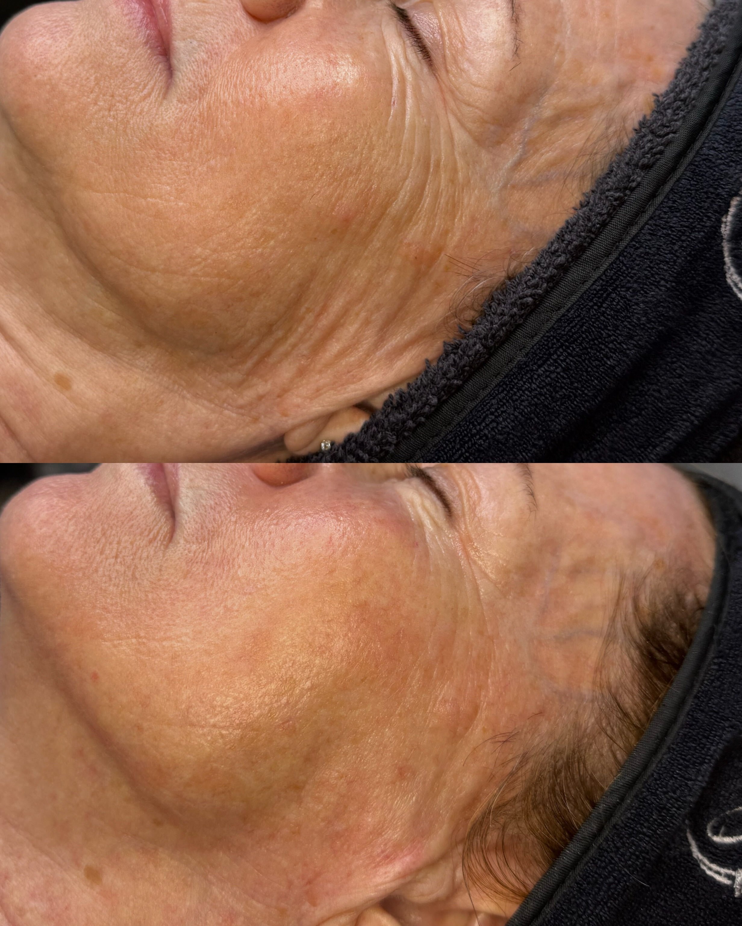 The results of three @skinpen Microneedling sessions! 

Microneedling is fantastic for many skin concerns like: fine lines, wrinkles, acne scars, acne, and hyperpigmentation. 

Have questions about Microneedling? Book a complimentary Microneedling co