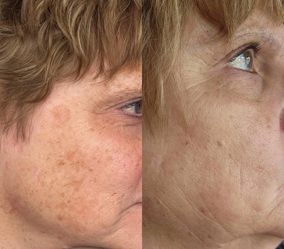 After only ONE IPL treatment for hyperpigmentation ⚡️ 

Wanting to clear up your summer sins? Schedule a complimentary IPL consultation with us! 
________

🗓️book your appointment using the link in bio 

Treatment by: Emily Anne
Name of Treatment: I