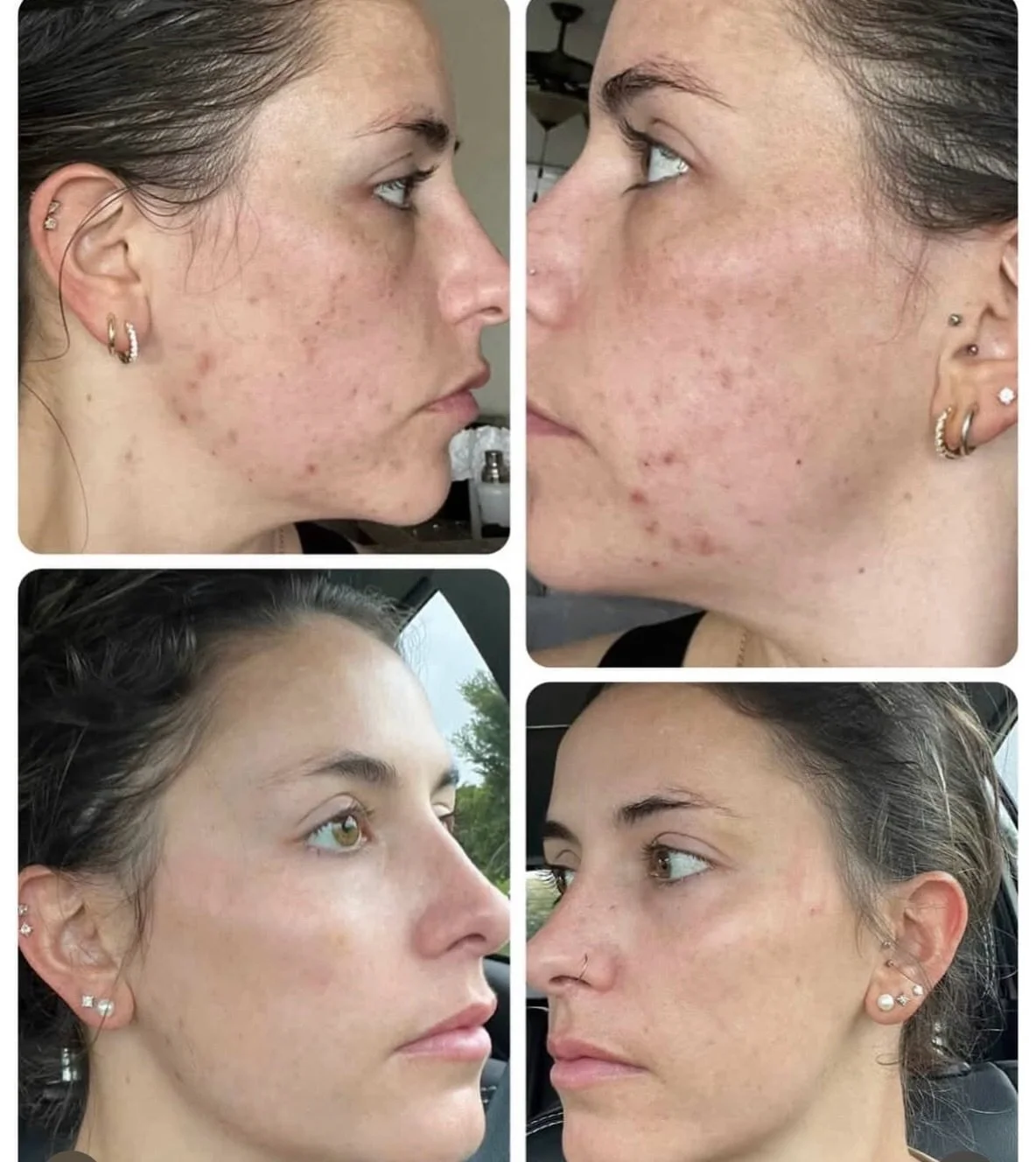IPL &amp; Microneedling Combo for this glowing win ✨ 
_________

🗓️book your appointment using the link in bio 

Treatment by: Emily Anne
Name of Treatment: IPL &amp; Microneedling 
Downtime: 24 hrs 
Cost: variable, all pricing on website, link in b