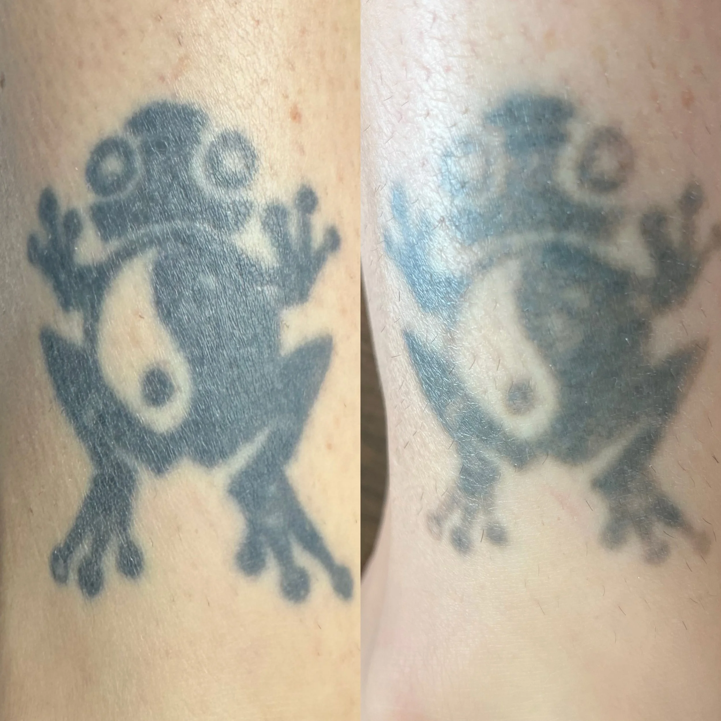 Reasons why we cannot tell you exactly how many sessions a tattoo will take to remove: 

1) placement of tattoo - the farther away from the heart it is the longer it will take to fade, the closer it is to your bodies natural circulatory system&hellip
