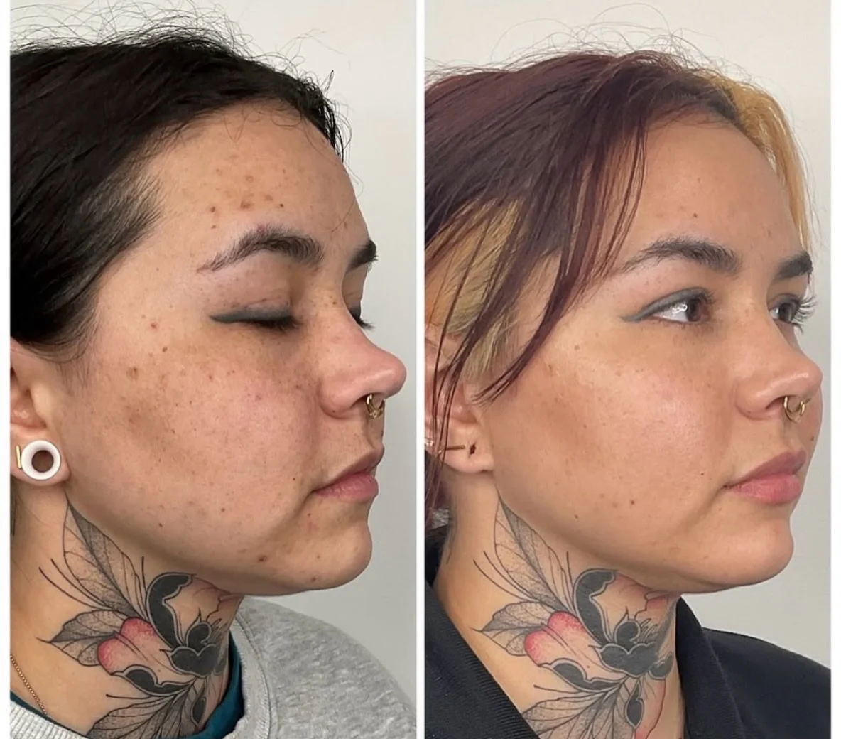 Microneedling w/ @ariessence.purepdgf for the win 
EVERYTIME ✨🙌
________

🗓️book your appointment using the link in bio 

Treatment by: @injectionsbysam_fnp 
Name of Treatment: Microneedling w/ PDGF
Downtime: 24 hrs 
Cost: single session $700 / pac