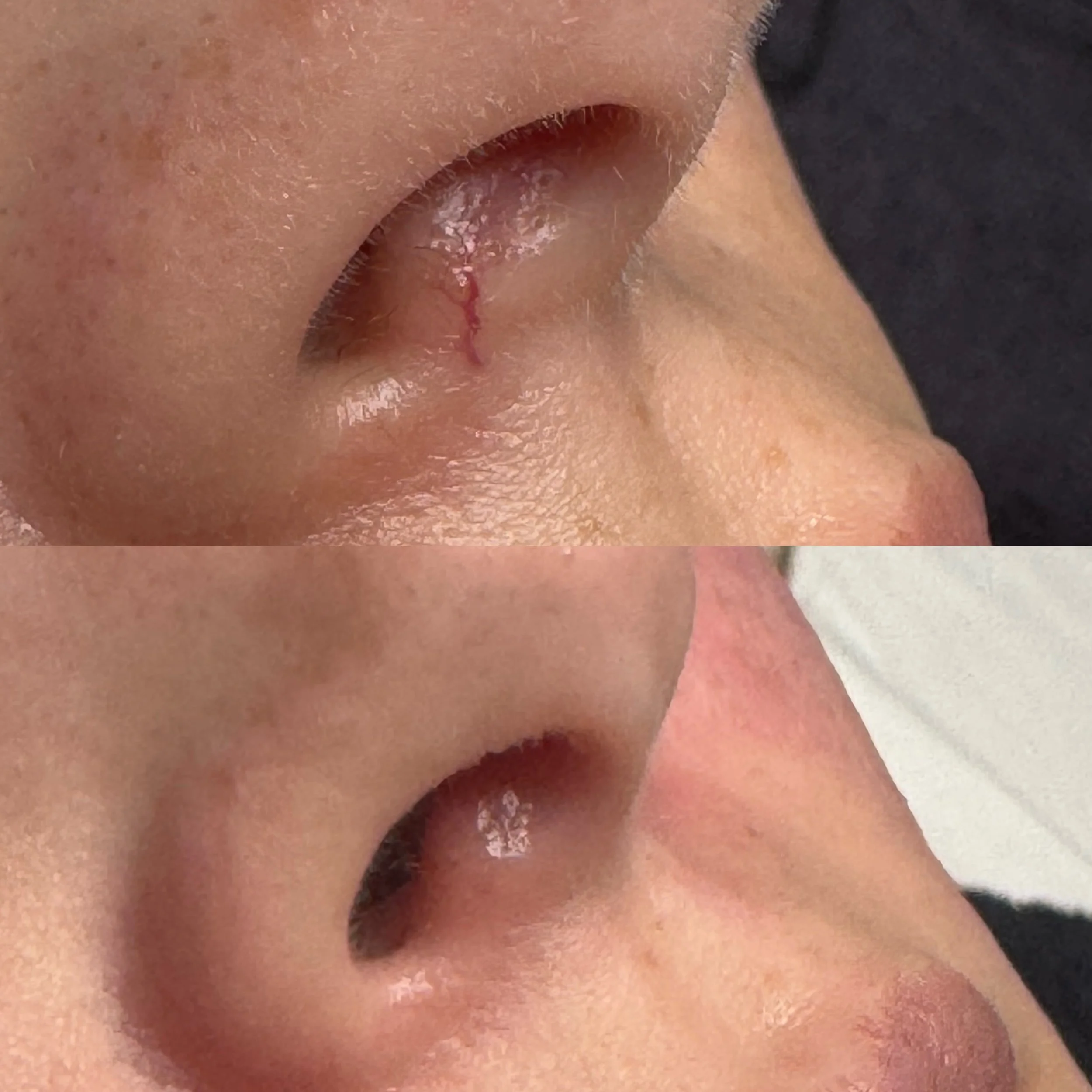 ⚡️ Poof! She gone! 💨 

Have stubborn veins? IPL might be the answer for you! Book a complimentary IPL consult with one of our service providers to see if it would be the right fit for you and your skin goals ⚡️ 
________

🗓️book your appointment us