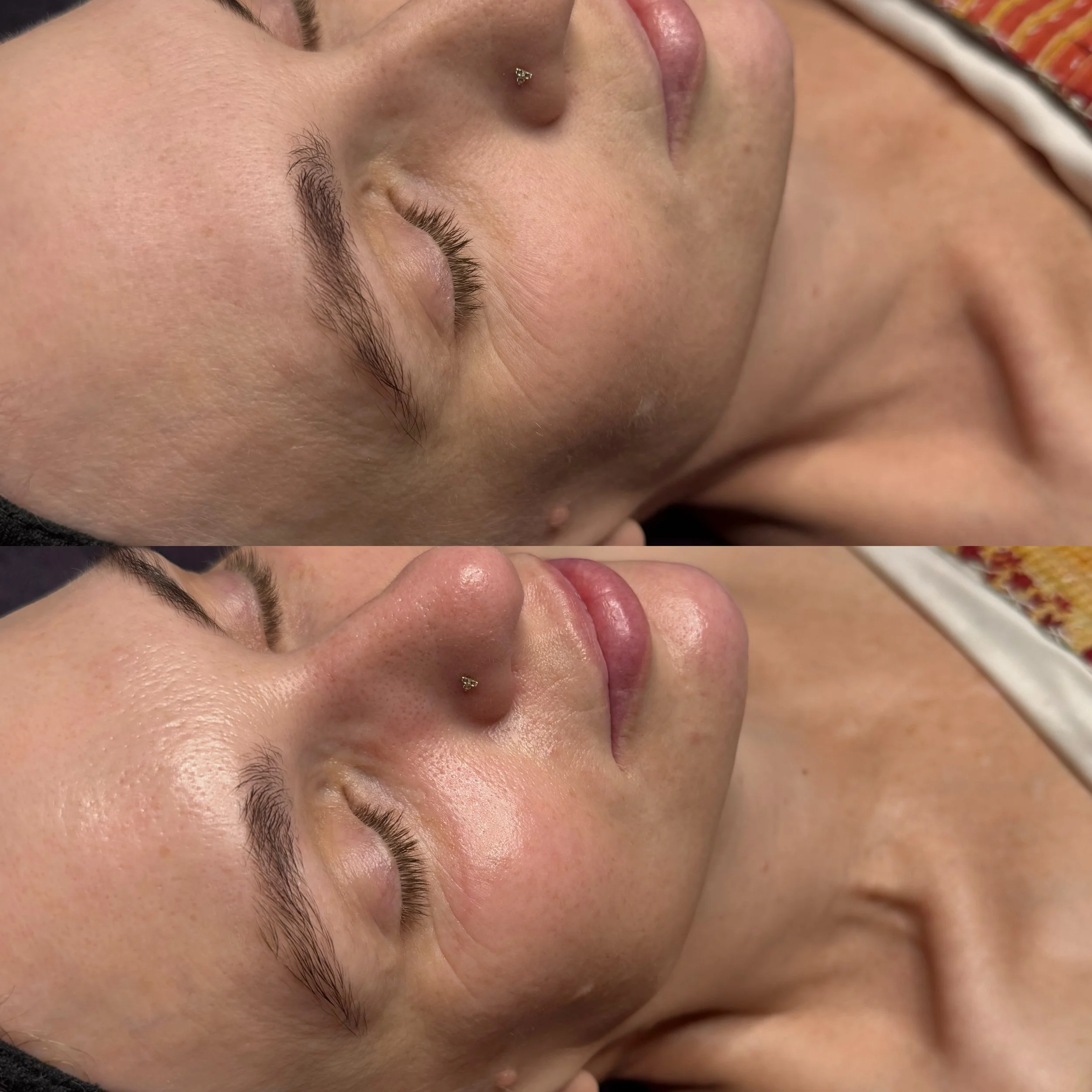 That&rsquo;s her bare skin with no finishing products on either. Simply a renewed and refreshed glow from her Deluxe @hydrafacial 💧 
_________

🗓️book your appointment using the link in bio 

Treatment by: Emily Anne
Name of Treatment: Deluxe Hydra