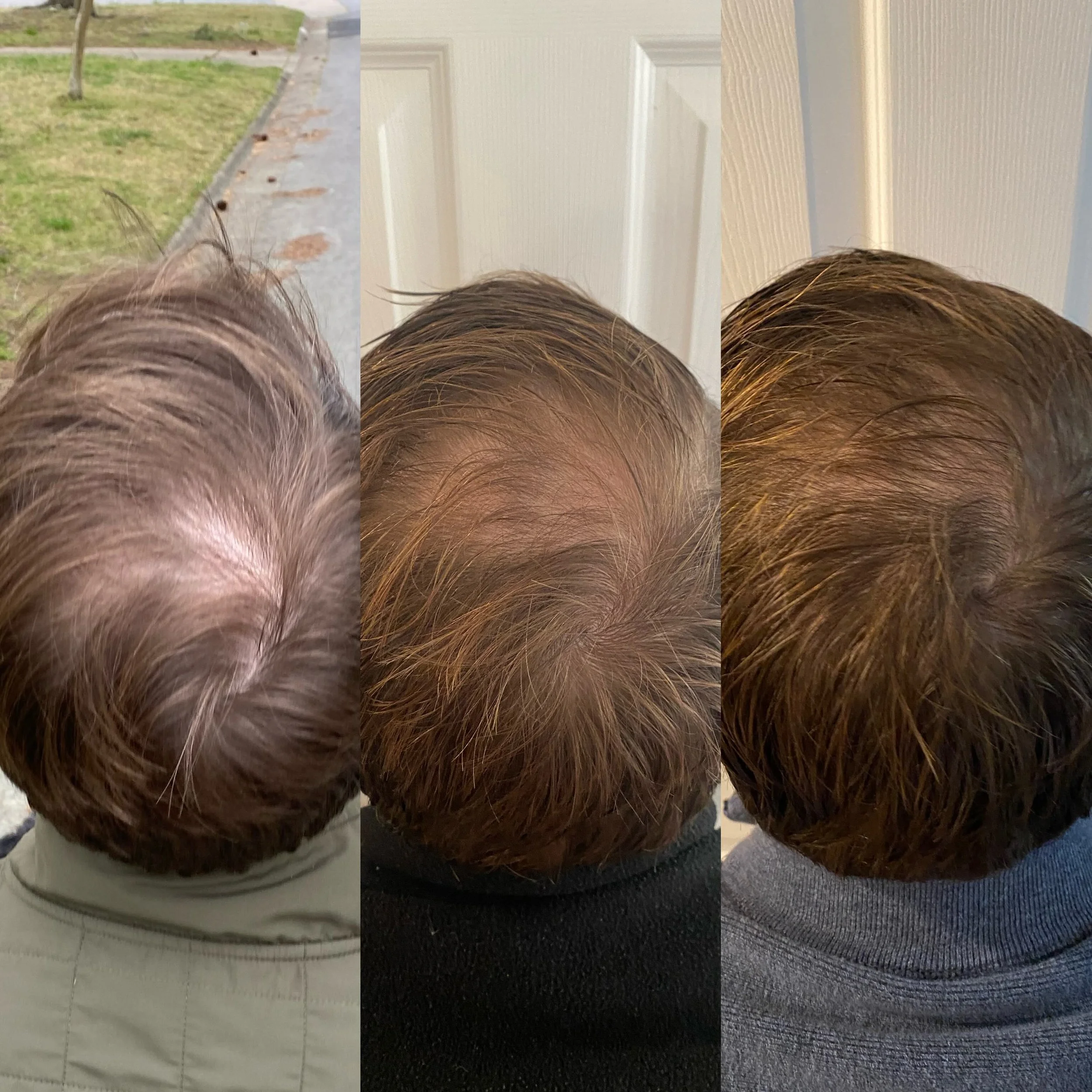 Close-up images of the top of a man's head showing progression of hair growing thicker.