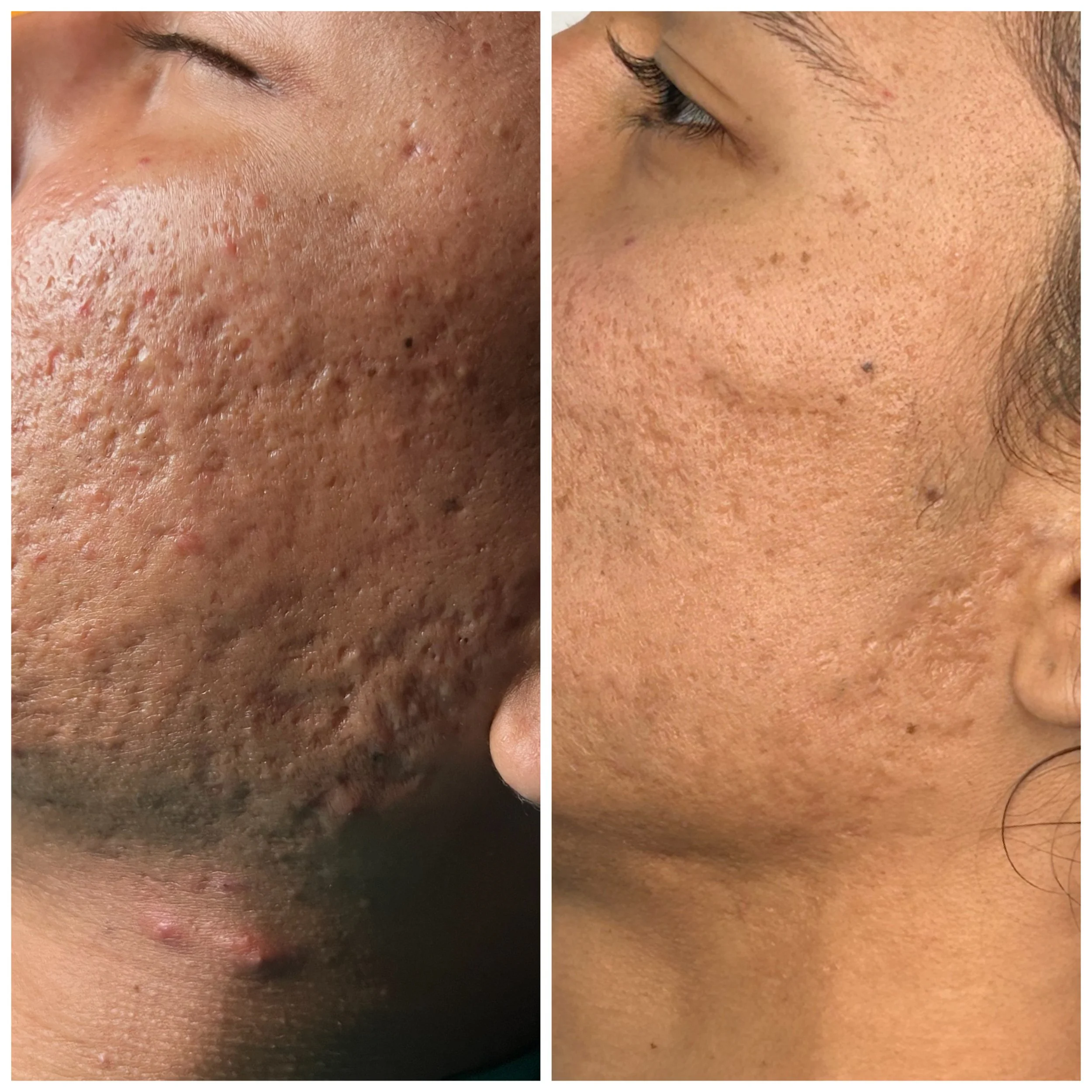 Comparison of a person's facial skin before and after treatment, showing improved skin texture, less acne, and reduced redness.