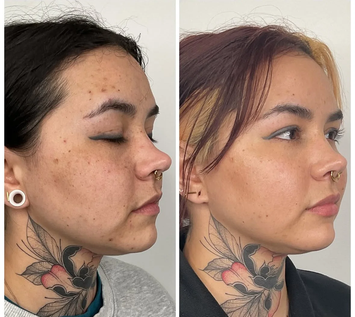 Side-by-side comparison of a woman before and after skincare or cosmetic treatment, showing clearer and more even skin tone on the right.