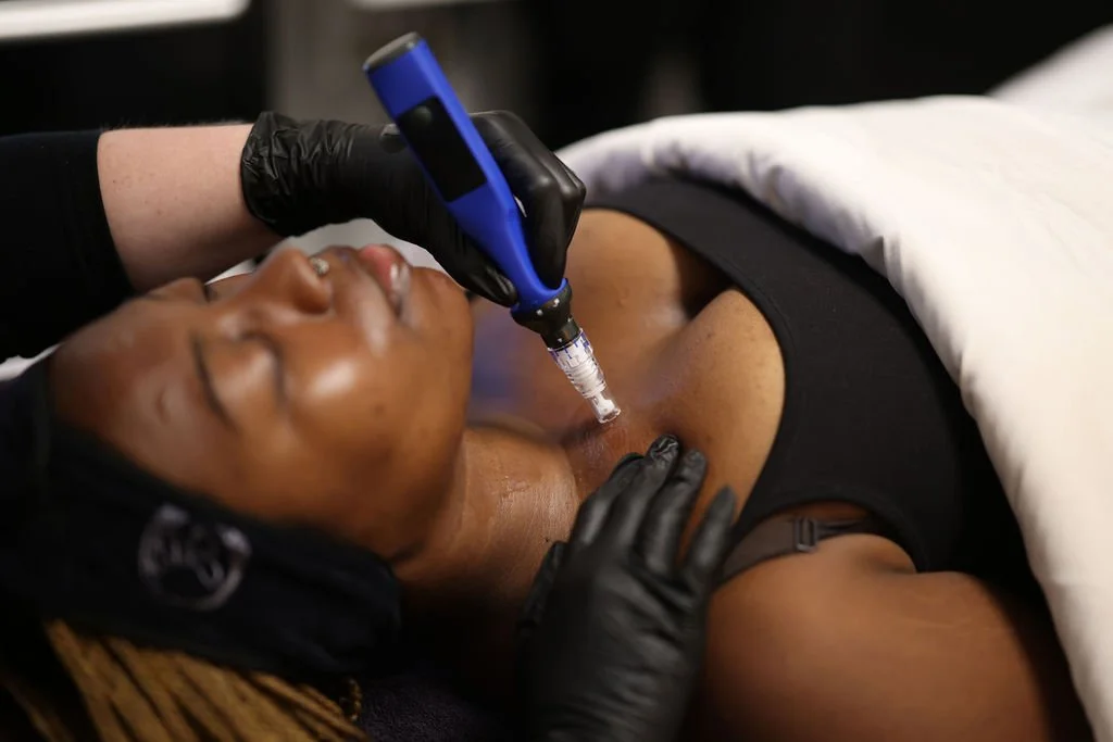 A person receiving a skinpen treatment using a handheld device on their chest while lying down.