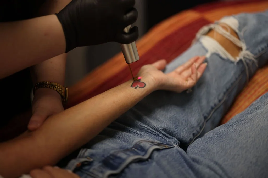 Everything You Need to Know About Tattoo Removal