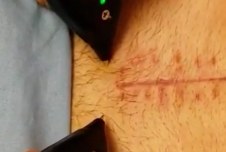 Your Incision Healed. So Why Does It Still Feel Tight?