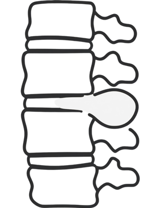 Illustration representing spinal discs and nerve-related pain