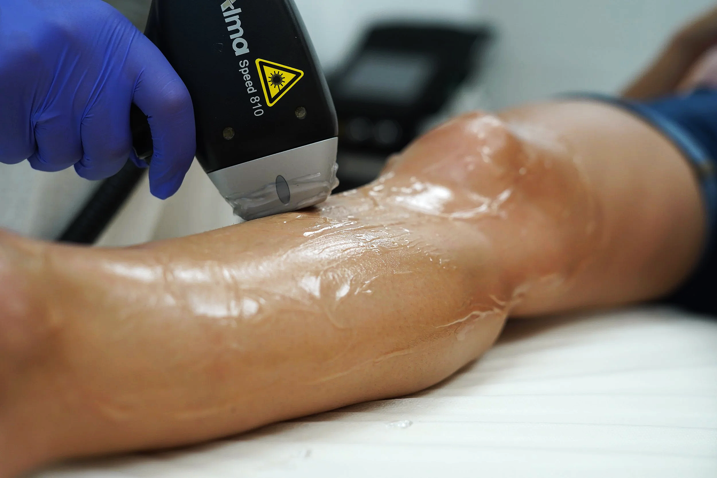Une main gantée de bleu utilisant un appareil d'épilation laser sur une jambe couverte de gel.