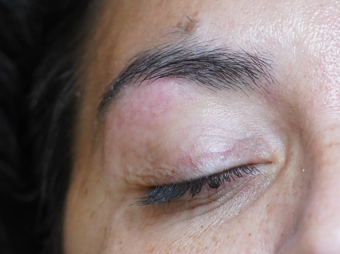 CLOSE-UP d'un œil fermé après epilation thermolyse