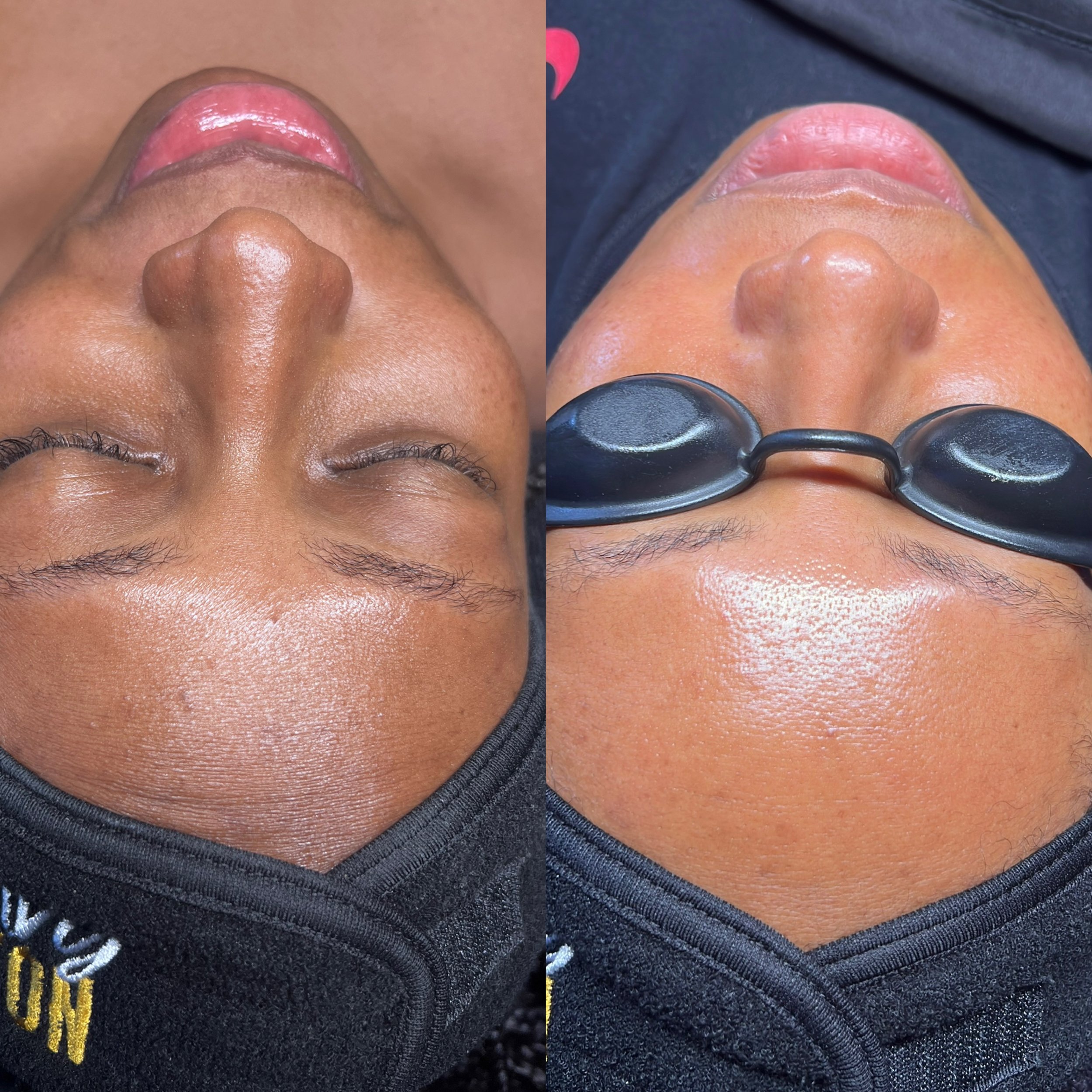A side-by-side comparison of a person's face before and after a cosmetic or skincare treatment, focusing on the nose and surrounding skin, with the person wearing glasses in the after photo.