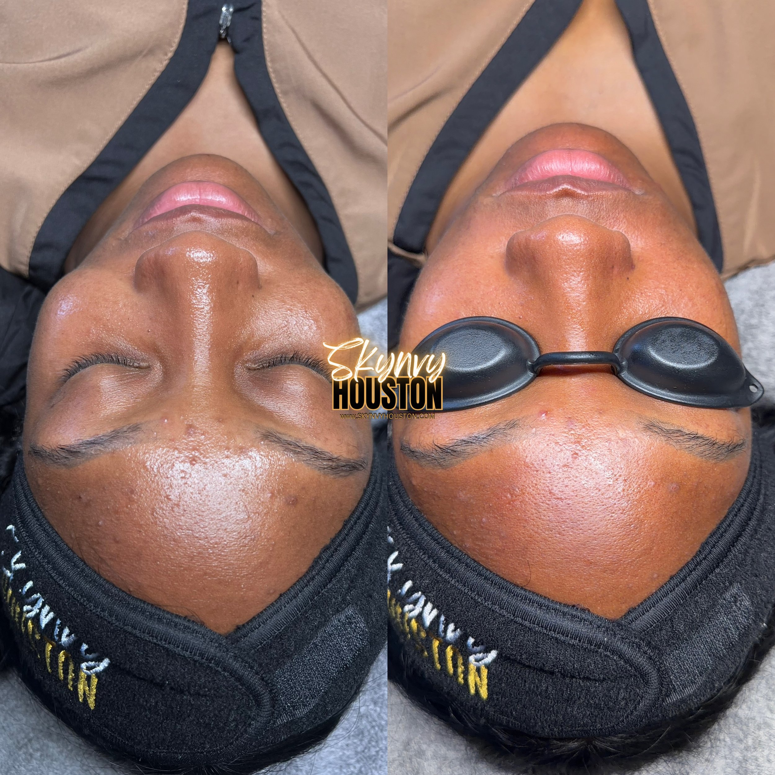 Close-up of a person's face, with the eyes closed, lying on a treatment table, during a skincare or facial treatment. The person is wearing glasses, and part of their head and upper chest are visible.