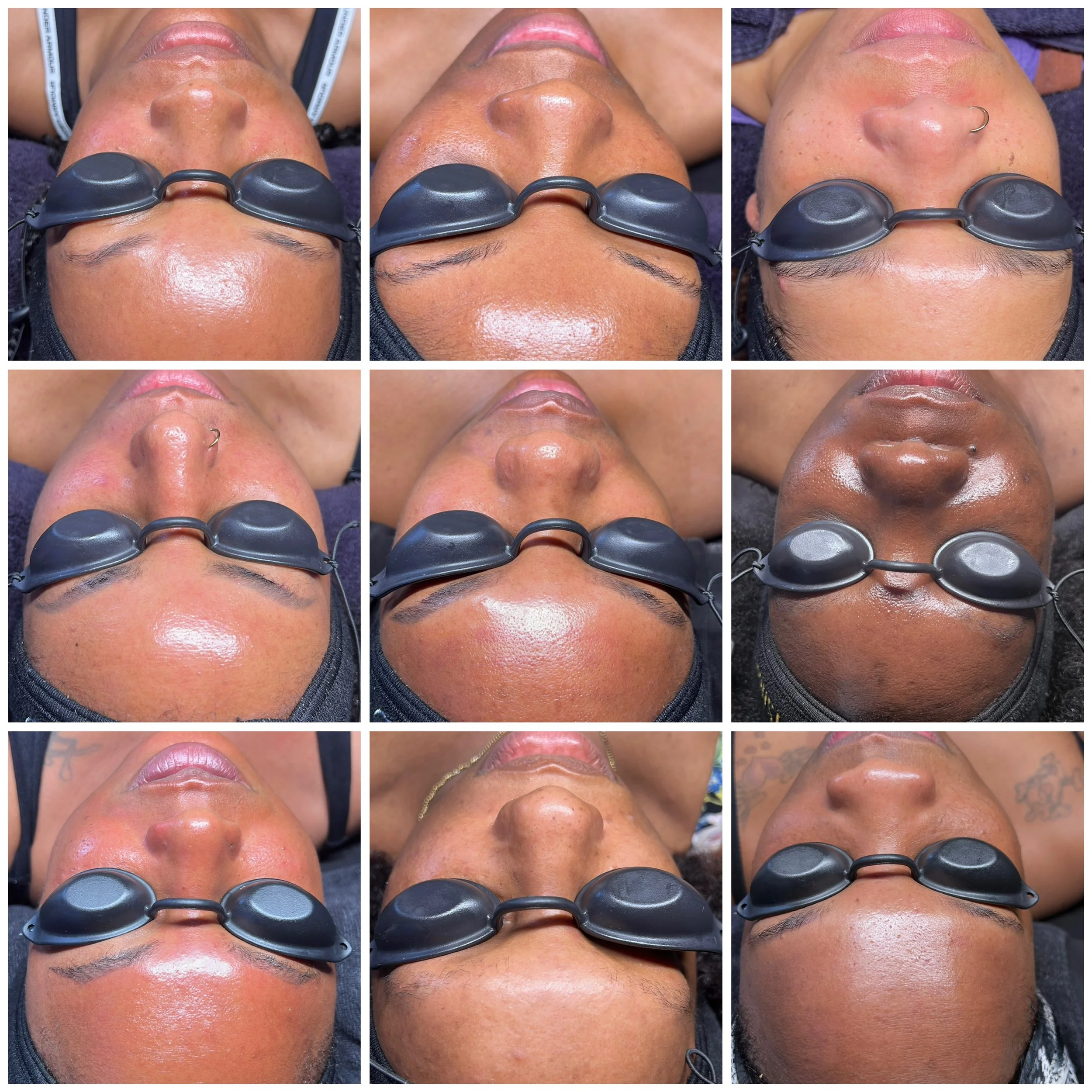 Series of close-up photos showing a person's face with a facial treatment, including a skin care mask or mask removal process.