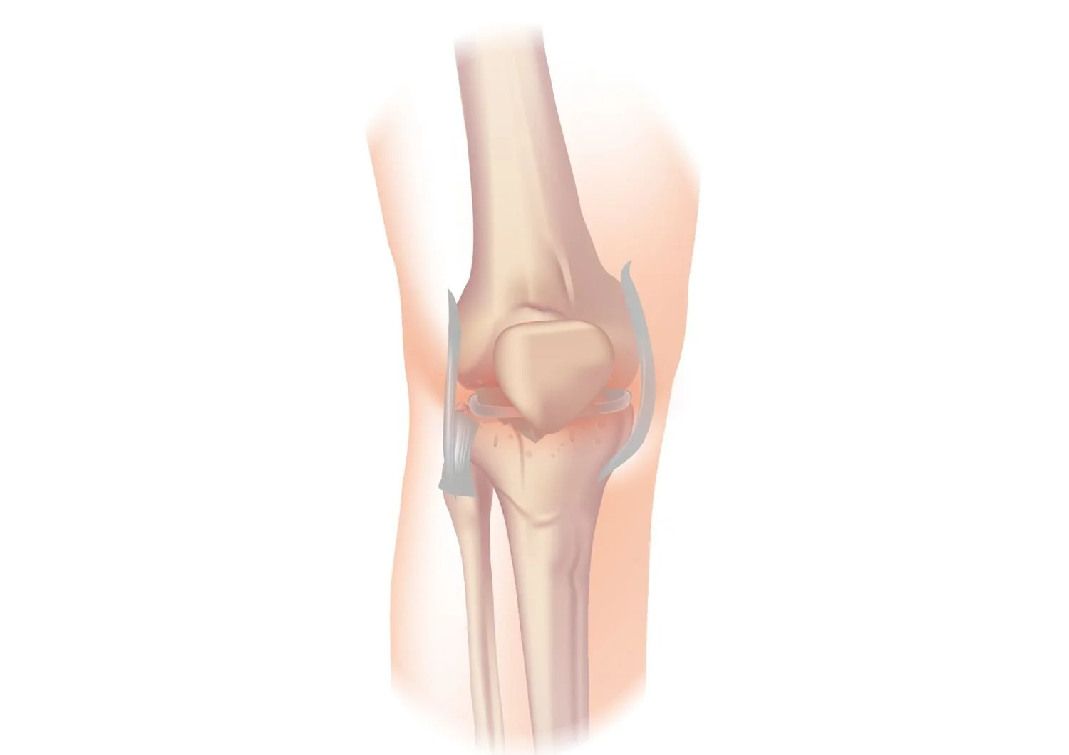 Illustration of a knee joint with osteoarthritis, showing worn cartilage and bone spurs between the thigh bone and shin bone.