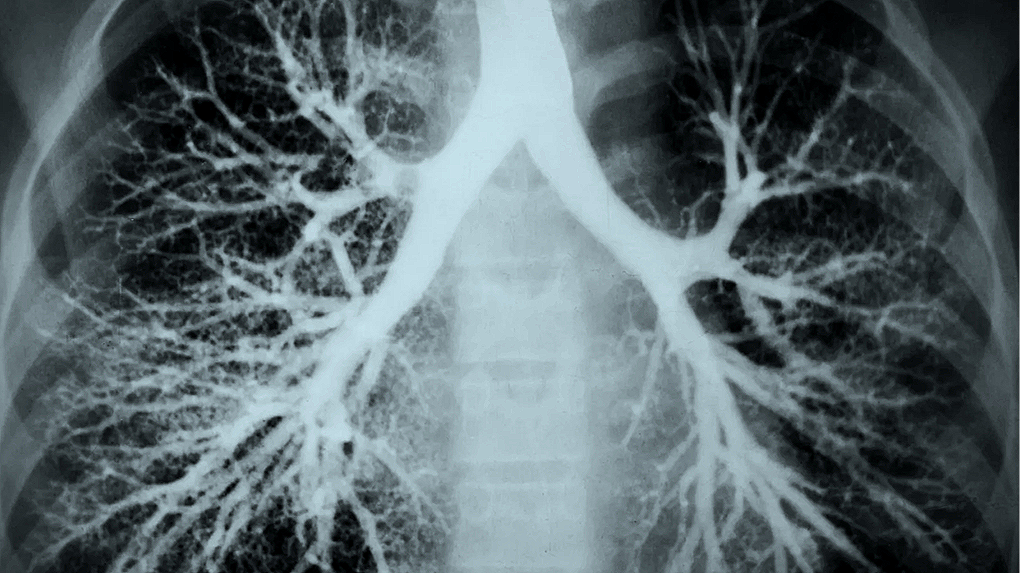 X-ray of human lungs showing bronchial tree and airway structures.