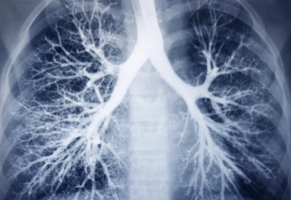X-ray image of human lungs showing the bronchial tree.
